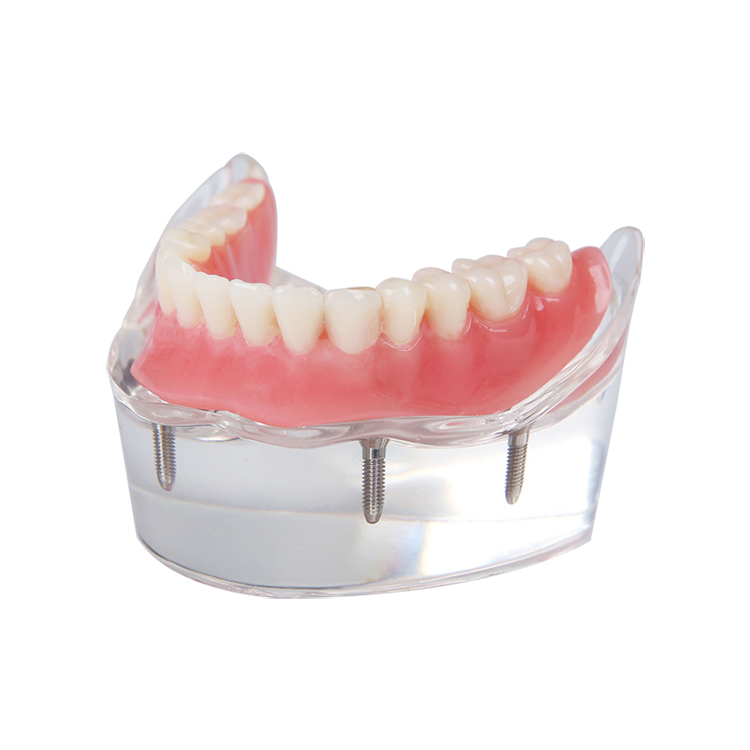 UM-6003 Modelo de sobredentadura com 4 implantes
   