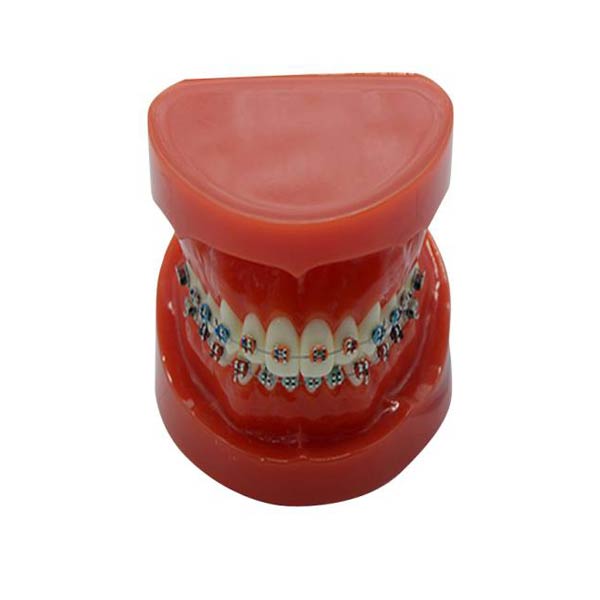 Modelo de estudo UM-B16 com aparelho fixo nos dentes (normal)
   