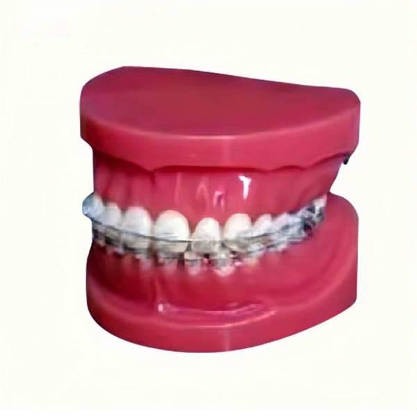Modelo de estudo UM-B17 com aparelho fixo nos dentes (Normal)